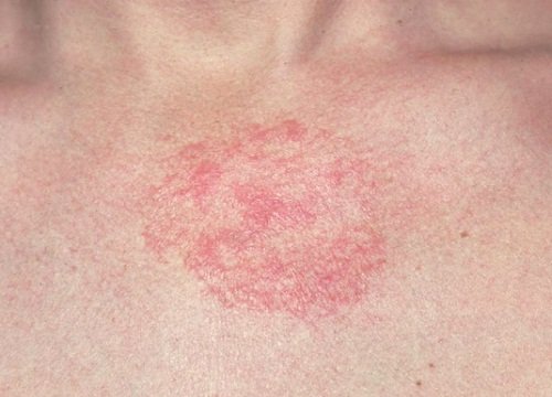 Atopowe zapalenie skóry – jak przynieść sobie ulgę?
