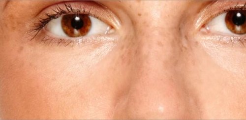 melasma na twarzy kobieta