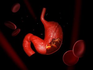Helicobacter pylori - najlepsze ziołowe remedia