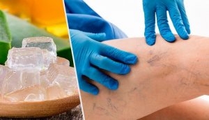 Naturalne leczenie żylaków - kilka opcji dla Ciebie