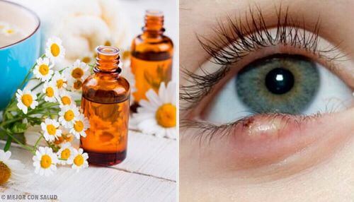 Jęczmień na powiece: 5 łatwych sposobów wyleczenia