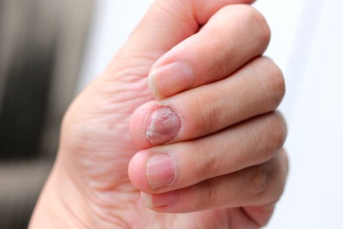 Łuszczyca na paznokciach – jak ją zwalczyć?