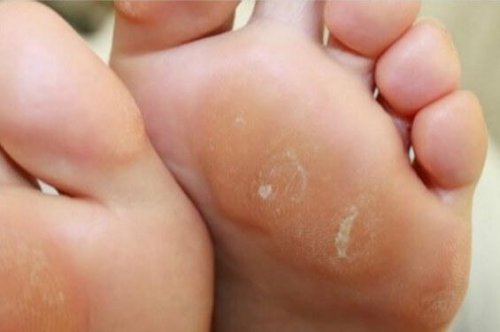 Modzele na stopach - sposób z cebulą i białym octem