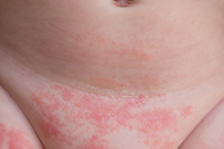 Pieluszkowe zapalenie skóry - jak go uniknąć?