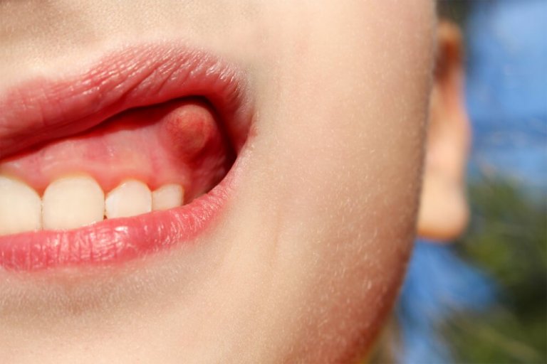 Ropień zęba - 10 domowych sposobów na ulgę!