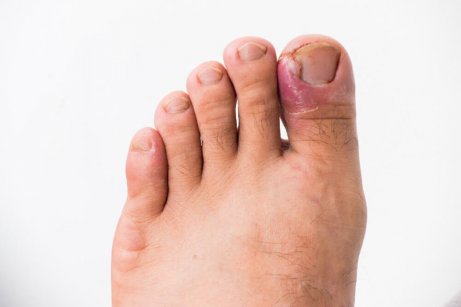 Wrastajace Paznokcie 5 Naturalnych Rozwiazan Krok Do Zdrowia