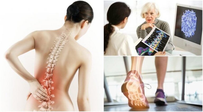 Osteoporoza.