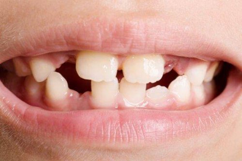 Agenezja zawiązków zębów - rodzaje i leczenie
