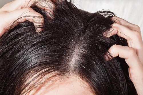 Przyczyny wypadania włosów wiążą się również ze stanem skóry głowy.
