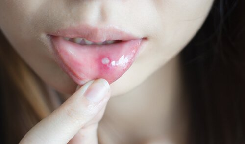 Afty i owrzodzenia w jamie ustnej - jak je leczyć?