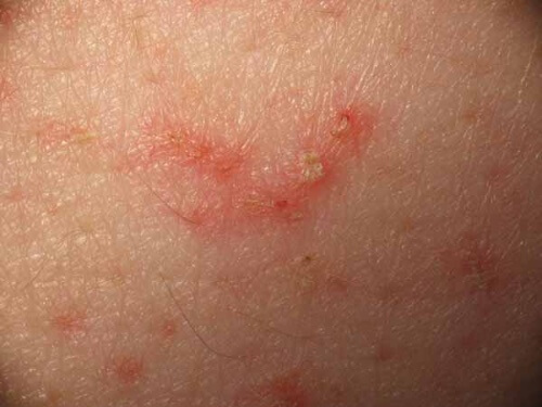 Aloes łagodzi skórne reakcje alergiczne.