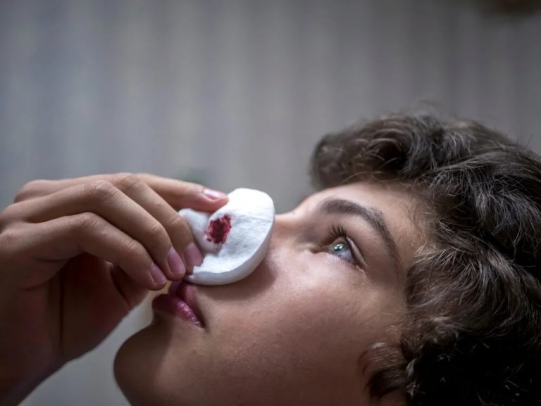 Krwotok z nosa - remedia, które pomogą go zatrzymać