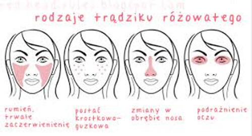 Trądzik różowaty