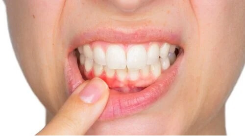 Ropień zębowy - co to jest i jak należy go leczyć?