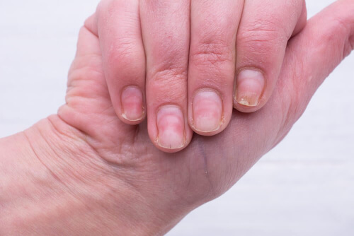 Sposób na żółte paznokcie - pofałdowane paznokcie