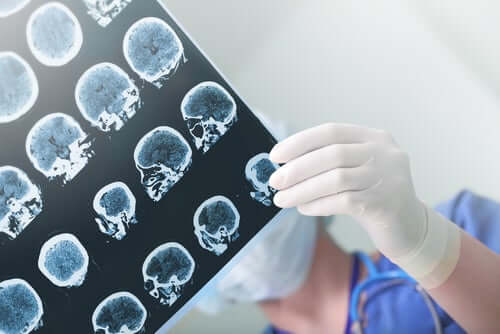 demencja zdjęcie neurologiczne