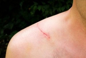 Naturalne kremy na blizny: jak się ich pozbyć?