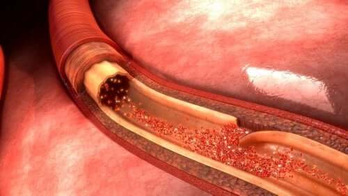 Rozwarstwienie aorty - jakie daje objawy?