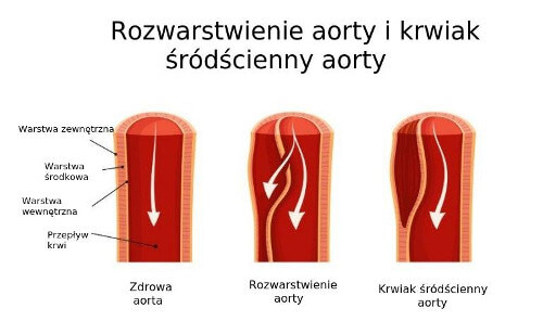 Rozwarstwienie aorty -schemat