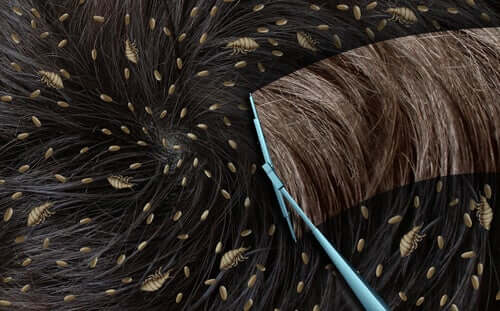 Gnidy i wszy we wsłosach