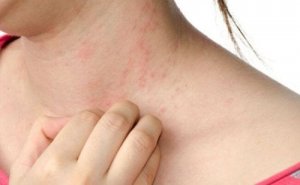 Dokuczliwa pokrzywka - naturalne środki łagodzące