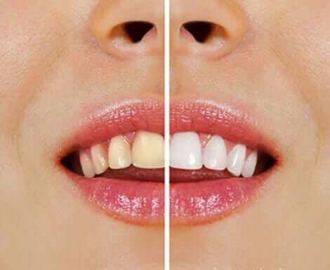 Białe i żółte zęby - naturalne sposoby wybielania zębów