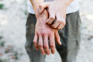 Wyprysk kontaktowy alergiczny - 6 sposobów