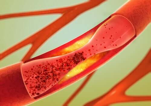 Otępienie naczyniowe - naczynia krwionośne