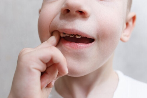 Próchnica zębów u dziecka