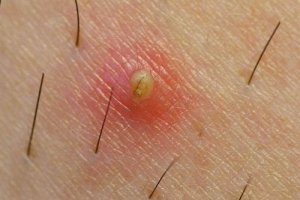 Wrastanie włosów - jak temu zapobiec?