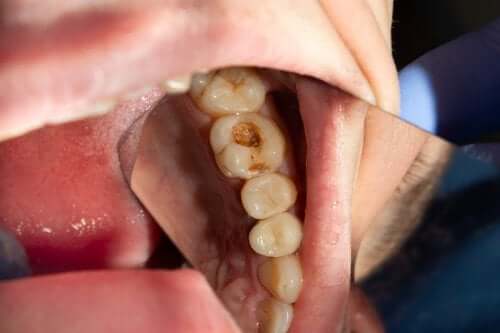 Próchnica zębów - co to jest i jak powstaje?