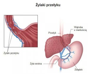 Żylaki przełyku - objawy, diagnoza i leczenie tej choroby
