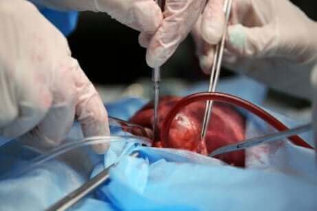 Operacja na otwartym sercu, sternotomia