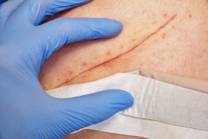 Leczenie ran - poznaj podstawowe techniki służące do tego celu