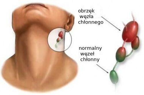 Węzły chłonne