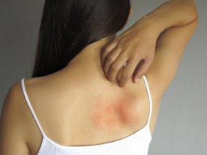 Łagodzenie wysypki – poznaj 5 środków o działaniu miejscowym