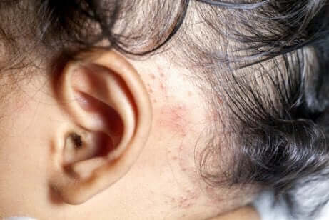 Łuszczyca za uchem