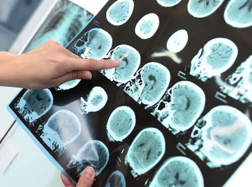 Demencja - poważne zaburzenie neurokognitywne