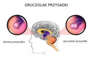 Guzy przysadki: poznaj bliżej ich przyczyny i typowe objawy