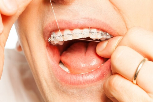 Higiena jamy ustnej z ortodoncją - nici