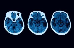 Zanik korowy tylny: poznaj metody diagnostyczne i sposoby leczenia