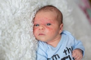 Atopowe, a łojotokowe zapalenie skóry - czym się różnią?