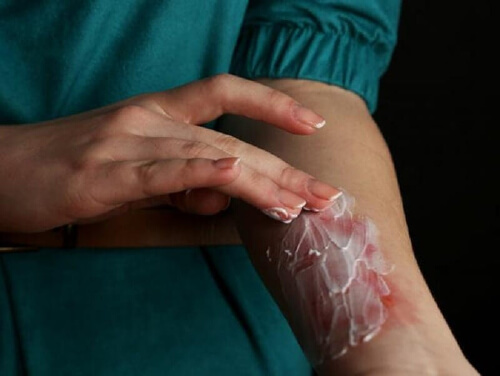 Krem na powierzchowne oparzenie