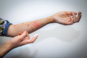 Powierzchowne oparzenie - jak udzielić pierwszej pomocy