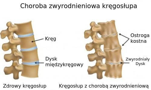 Choroba zwyrodnieniowa kręgosłupa
