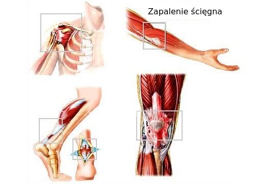 Uszkodzenia tkanek miękkich