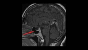 Gruczolak przysadki – dowiedz się więcej na jego temat