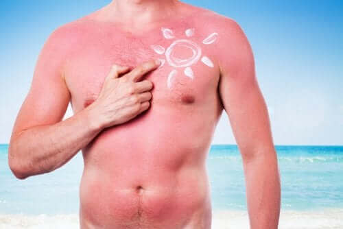 Oparzenie słoneczne - szkodliwy wpływ słońca na skórę