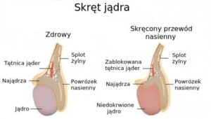 Skręt powrózka nasiennego: poznaj objawy i przyczyny tego problemu