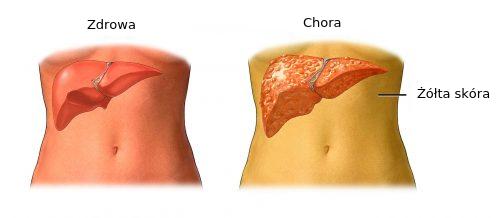 Objawy żółtaczki